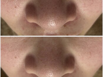 アンリミット 鹿児島天文館店(Une limit)/つまり毛穴がお悩み