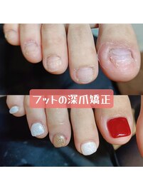 フットの深爪矯正で魅せる足元へ