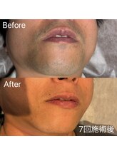 エピノン 山口岩国店(Epinon)/顔脱毛　ビフォーアフター