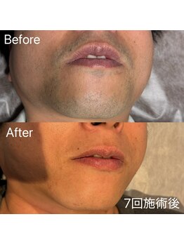 エピノン 山口岩国店(Epinon)/顔脱毛 ビフォーアフター