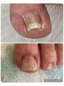 【フット】見た目美しい巻き爪ケア¥11,550から。内容要確認!クーポン初掲載