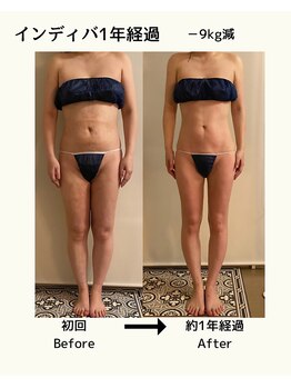 ウィッシュプロサロンケー(WISHpro salon K)/インディバ術後ケア～1年経過　