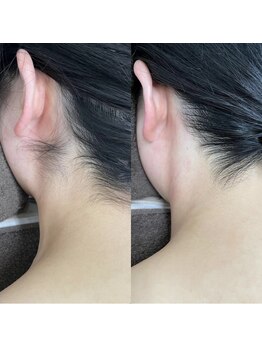 カルディエ(Cardie)/うなじ脱毛　ビフォーアフター