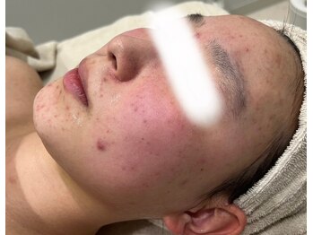 アンドユー ヨコハマ(&U Yokohama)/クリスティーナ施術前