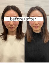 長寿鍼灸院 長寿整骨院/美容鍼50本の効果★小顔効果