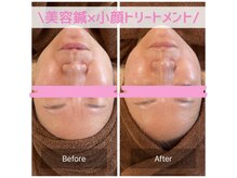 鍼灸院 はりのひと/美容鍼×整顔フェイシャル♪