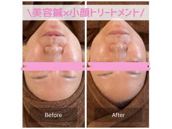 鍼灸院 はりのひと/美容鍼×整顔フェイシャル♪