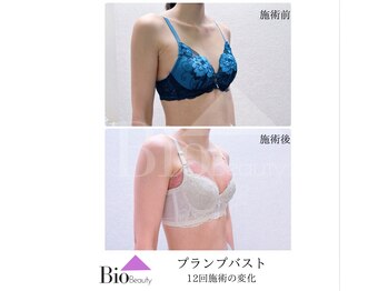 バイオビューティー 神戸本店(Bio Beauty)/プランプバスト 12回コース症例