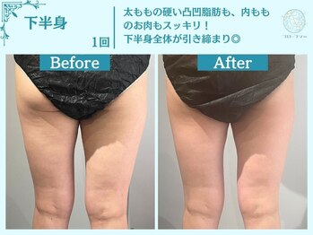 フローフシ∞/【痩身】下半身・お尻の脂肪撃退