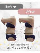 ミネット(minette)/脂肪冷却＊before→after