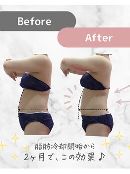 ミネット(minette)/脂肪冷却*before→after