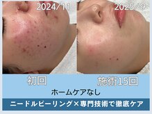 アロマ(AROMA)/　ニキビ・凹凸跡・毛穴改善