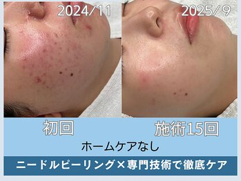 アロマ(AROMA)/　ニキビ・凹凸跡・毛穴改善