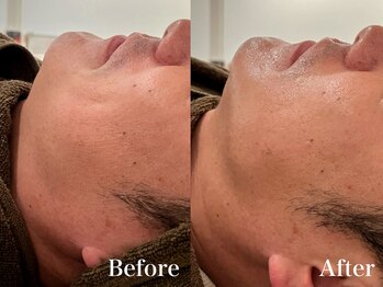 シャルム(Charme)/メンズフェイシャル♪たるみケア