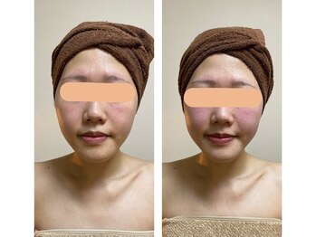 ドリーム(dRe:am)/小顔コルギ