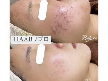 アールズ スリム(R's slim)/ハーブ★HAABフェイシャル