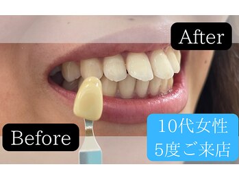 ホワイトニングカフェ 平塚店(WhiteningCafe)/◎歯のホワイトニング施術写真◎