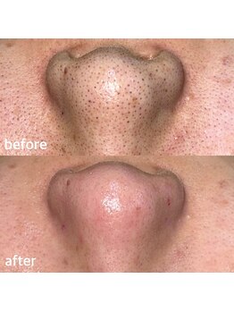 シェリーミル(Cherie Miru)/エクストラクションBefore/After