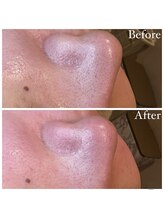 マドモアゼル 麻布十番/毛穴洗浄