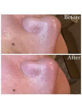 マドモアゼル 麻布十番/毛穴洗浄