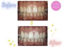 エクシアホワイトニング エミフルMASAKI店/ホワイトニングビフォーアフター