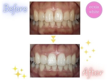 エクシアホワイトニング エミフルMASAKI店/ホワイトニングビフォーアフター