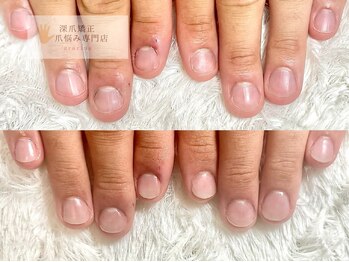 グレースレディ 大阪店/(深爪/長さだし/フィルイン)