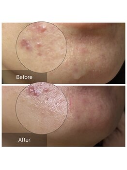 カノン(Kanon)/アフターニキビ肌