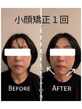 リバイブ 自由が丘店(REVIVE)/小顔矯正+ドライヘッドスパ1回