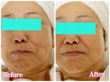 ララン(Laran)/ハイドラ＆光フェイシャル