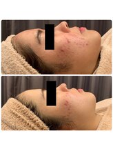 オーシャン(OCEAN)/お肌トラブルにvosサロンケア