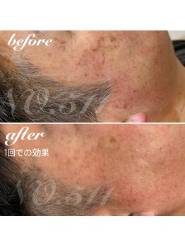 ナンバー511(No.511)/シミケア