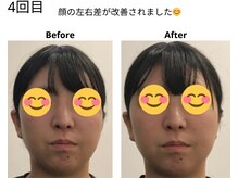 ベル/20代の方の小顔Before After