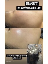 シェーングランツ(SchonGlanz)/ここまで変わる角質ケア