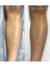 ルシャトン(Le Chaton)/あし脱毛