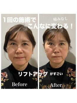 ニコ(NICO)/ビフォーアフター　１回目