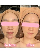 クラッシーガール ダンディエール(QlassyGirl DANDYELL)/【３０代】５回後/ピーリング