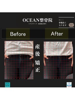 オーシャン整骨院(OCEAN整骨院)/産後矯正の骨盤ビフォーアフター