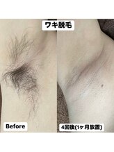 ミノア 大野城店(MINOA)/ワキ脱毛