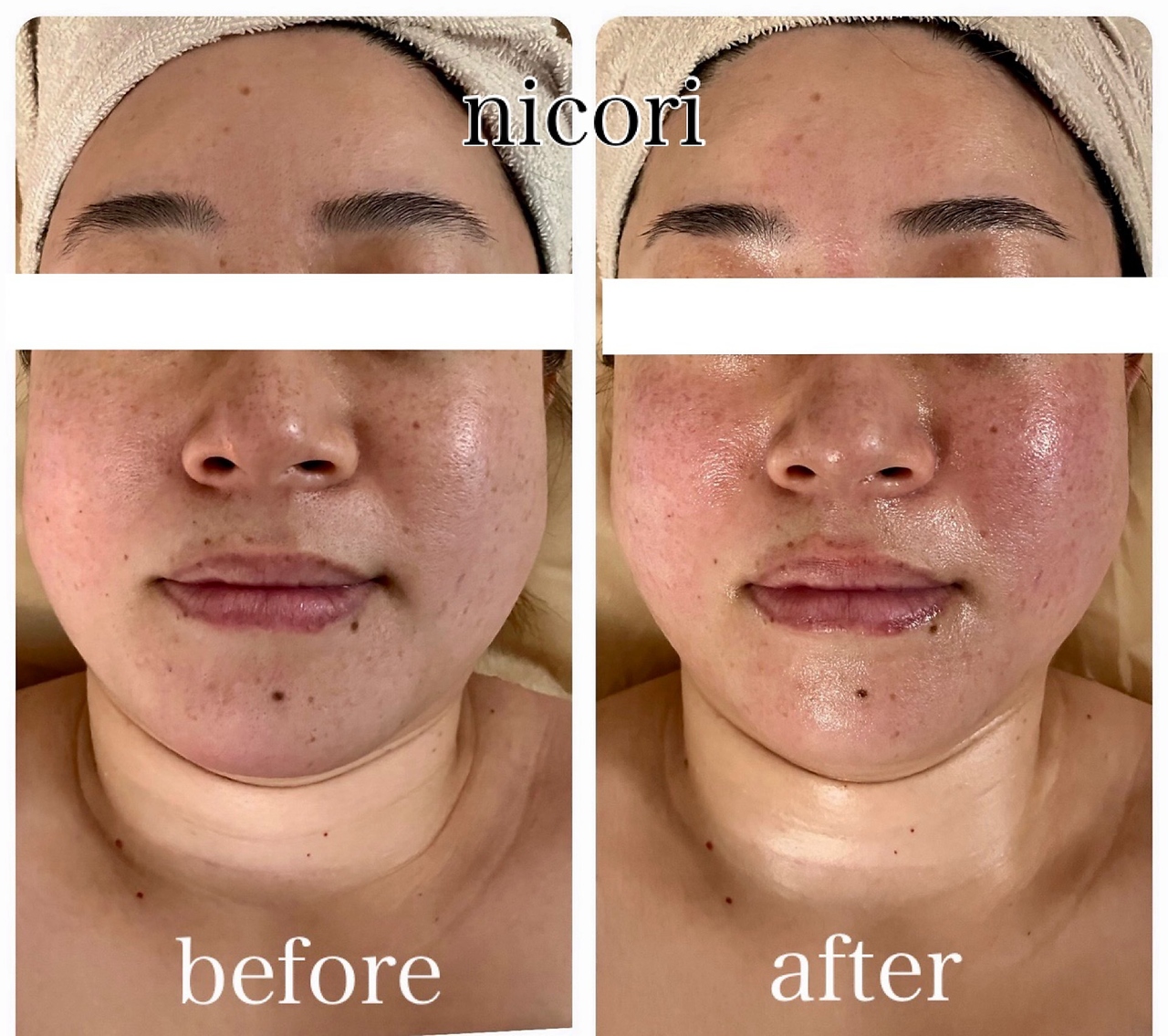 ニコリ(nicori)/小顔矯正　beforeとafter