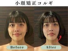 スイスパ 恵比寿(翠SUI SPA)/【小顔矯正コルギ】Before/After