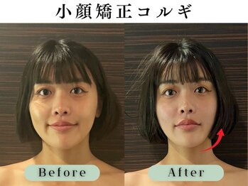 スイスパ 恵比寿(翠SUI SPA)/【小顔矯正コルギ】Before/After