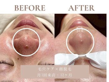 サエラ(SAERA)/毛穴ケア×顔脱毛【12回】