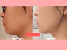 リライブ 亀有店(Re:Lives)/小顔美肌のお客様の口コミ♪