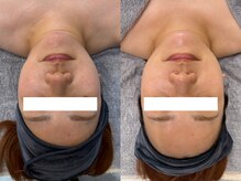 キレイ美肌 北心斎橋店/小顔/マイクロウェーブリフト