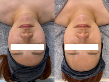 キレイ美肌 北心斎橋店/小顔/マイクロウェーブリフト