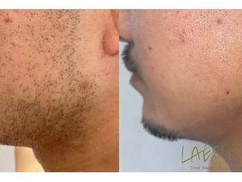 ラエッセ(LAESSE)/<メンズ>ヒゲ脱毛