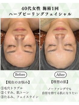 シーフェイス 横浜店(SEE FACE)/毛穴肌質改善ハーブピーリング