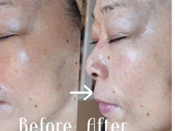 マールム(MALUM)/メソスキンカラー　フェイシャル