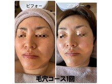 ミヤビ(MIYABI)の雰囲気(毛穴専用の美容液で、余分な皮脂をしっかり浮かせます!)